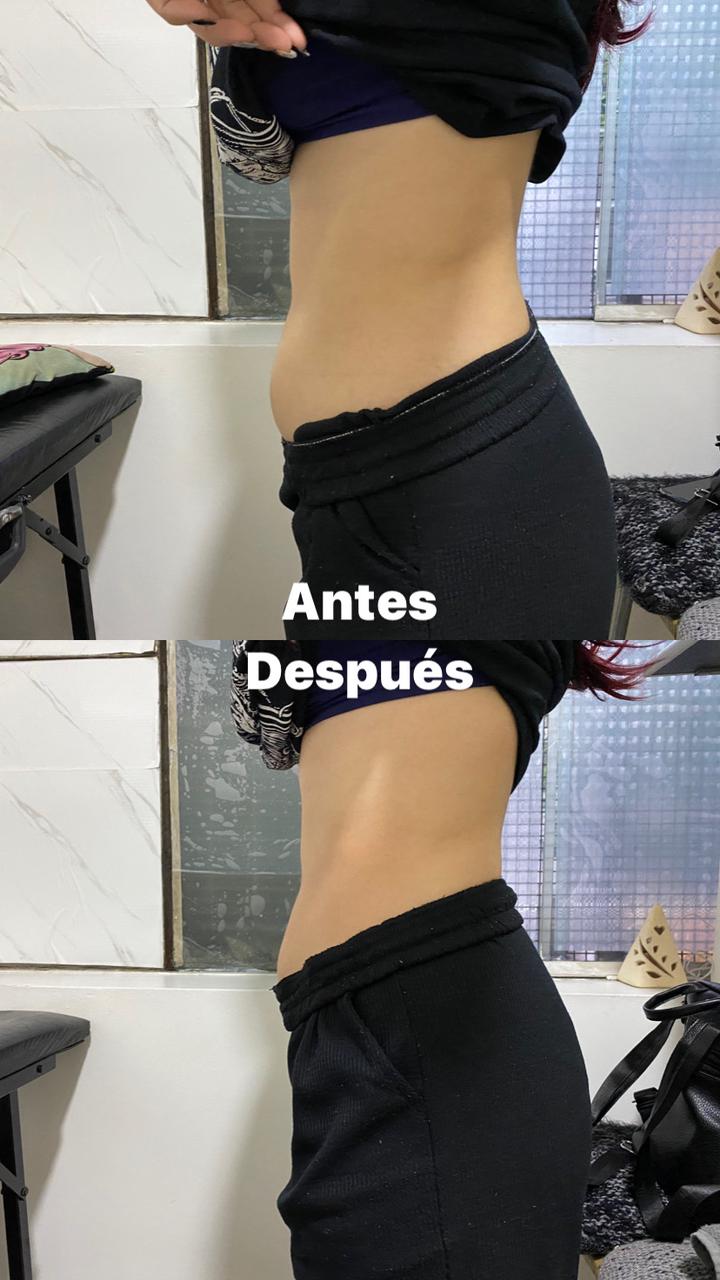 Tratamiento Velaslim